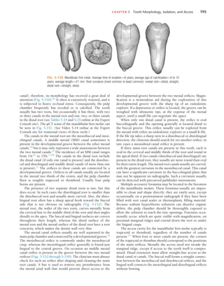 CHAPTER 5  Tooth Morphology, Isolation, and Access	 195
FIG. 5-150  Mandibular first molar. Average time of eruption—6 years; average age of calcification—9 to 10
years; average length—21 mm. Root curvature (most common to least common): mesial root—distal, straight;
distal root—straight, distal.
canal); therefore, its morphology has received a great deal of
attention (Fig. 5-150).261
It often is extensively restored, and it
is subjected to heavy occlusal stress. Consequently, the pulp
chamber frequently has receded or is calcified. The tooth
usually has two roots, but occasionally it has three, with two
or three canals in the mesial root and one, two, or three canals
in the distal root (see Tables 5-24 and 5-25 online at the Expert
Consult site). The µCT scans of the mandibular first molar can
be seen in Fig. 5-151. (See Video 5-14 online at the Expert
Consult site for rotational views of these teeth.)
The canals in the mesial root are the mesiobuccal and mesi-
olingual canals. A middle mesial (MM) canal sometimes is
present in the developmental groove between the other mesial
canals,148
but it may only represent a wide anastomosis between
the two mesial canals.54
The incidence of an MM canal ranges
from 1%223
to 15%.77,209
The canals in the distal root include
the distal canal (if only one canal is present) and the distobuc-
cal and distolingual and middle distal canals (if more than one
is present).75
The orifices to these canals are connected by a
developmental groove. Orifices to all canals usually are located
in the mesial two thirds of the crown, and the pulp chamber
floor is roughly trapezoid or rhomboid. Usually four pulp
horns are present.
The presence of two separate distal roots is rare, but this
does occur. In such cases the distolingual root is smaller than
the distobuccal root and usually more curved. Also, the disto-
lingual root often has a sharp apical hook toward the buccal
side that is not obvious on radiographs (Fig. 5-152). The
mesial root, the wider of the two roots, curves mesially from
the cervical line to the middle third of the root and then angles
distally to the apex. The buccal and lingual surfaces are convex
throughout their length, whereas the distal surface of the
mesial root and the mesial surface of the distal root have a root
concavity, which makes the dentin wall very thin.
The mesial canal orifices usually are well separated in the
main pulp chamber and connected by a developmental groove.40
The mesiobuccal orifice is commonly under the mesiobuccal
cusp, whereas the mesiolingual orifice generally is found just
lingual to the central groove. On occasion an middle mesial
canal orifice is present in the groove between the two mesial
orifices (Figs. 5-152 through 5-159). The clinician must always
check for such an orifice after shaping and cleaning the main
root canals. A bur is used to remove any protuberance from
the mesial axial wall that would prevent direct access to the
developmental groove between the two mesial orifices. Magni-
fication is a tremendous aid during the exploration of this
developmental groove with the sharp tip of an endodontic
explorer. If a depression or orifice is located, the groove can be
troughed with ultrasonic tips, at the expense of the mesial
aspect, until a small file can negotiate the space.
When only one distal canal is present, the orifice is oval
buccolingually and the opening generally is located distal to
the buccal groove. This orifice usually can be explored from
the mesial with either an endodontic explorer or a small K-file.
If the file tip takes a sharp turn in a distobuccal or distolingual
direction, the clinician should search for yet another orifice; in
rare cases a mesiodistal canal orifice is present.
If three main root canals are present in this tooth, each is
oval in the cervical and middle thirds of the root and round in
the apical third. If two canals (distobuccal and distolingual) are
present in the distal root, they usually are more round than oval
for their entire length. The mesial root canals usually are curved,
with the greatest curvature in the mesiobuccal canal. This canal
can have a significant curvature in the buccolingual plane that
may not be apparent on radiographs. Such a curvature usually
can be detected with precurved pathfinder instruments.
Multiple accessory foramina may be located in the furcation
of the mandibular molars. These foramina usually are impos-
sible to clean and shape directly; they are rarely seen, except
occasionally on a posttreatment radiograph if they have been
filled with root canal sealer or thermoplastic filling material.
Because sodium hypochlorite solutions can dissolve organic
debris, the pulp chamber should be thoroughly exposed to
allow the solution to reach the tiny openings. Fractures occa-
sionally occur, which are quite visible with magnification, on
proximal marginal ridges and extend down the root or under
the lingual cusps.
The access cavity for the mandibular first molar typically is
trapezoid or rhomboid, regardless of the number of canals
present.247
When four or more canals are present, the corners
of the trapezoid or rhombus should correspond to the positions
of the main orifices. Mesially the access need not invade the
marginal ridge, except if access to the tooth itself is compro-
mised. Distal extension must allow straight-line access to the
distal canal or canals. The buccal wall forms a straight connec-
tion between the mesiobuccal and distobuccal orifices, and the
lingual wall connects the mesiolingual and distolingual orifices
without bowing.
 