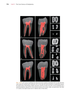 196	 PART I  The Core Science of Endodontics
FIG. 5-151  µCT scans of mandibular first molars. A, Common anatomic presentation. B, First molar with three
main canals and a deviant fourth canal/fourth root. C, First molar with wide connections or anastomoses between
the mesial canals, demonstrating multiple canal exits. All teeth are shown from both a buccal (vestibular) and a
proximal perspective, along with the cross-sectional anatomy at the coronal, middle, and apical levels. (See Video
5-14 online at the Expert Consult site for rotational views of these teeth.)
A
B
C
 