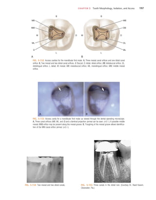 CHAPTER 5  Tooth Morphology, Isolation, and Access	 197
FIG. 5-152  Access cavities for the mandibular first molar. A, Three mesial canal orifices and one distal canal
orifice. B, Two mesial and two distal canal orifices. B, Buccal; D, distal, distal orifice; DB, distobuccal orifice; DL,
distolingual orifice; L, labial; M, mesial; MB, mesiobuccal orifice; ML, mesiolingual orifice; MM, middle mesial
orifice.
A
B
M
MB
MM
ML
D
D
L
B
B
M
MB
DB
DL
ML
D
L
FIG. 5-153  Access cavity for a mandibular first molar as viewed through the dental operating microscope.
A, Three canal orifices (MB, ML, and D) and a dentinal projection (arrow) can be seen. (×5.1.) A possible middle
mesial (MM) orifice may be present along the mesial groove. B, Troughing of the mesial groove allows identifica-
tion of the MM canal orifice (arrow). (×5.1.)
B
A
FIG. 5-154  Two mesial and two distal canals. FIG. 5-155  Three canals in the distal root. (Courtesy Dr. Raed Kasem,
Clearwater, Fla.)
 