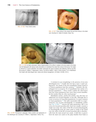 198	 PART I  The Core Science of Endodontics
FIG. 5-156  Three mesial canals.
FIG. 5-157  Three orifices in the mesial root and three orifices in the distal
root. (Courtesy Dr. Haider Al Zubaidi, Ocala, Fla.)
FIG. 5-158  A, Radix entomolaris. Notice lingual position of its orifice in relation to the two canals in the distal
root. B, Radiograph with obvious radix entomolaris on mandibular first molar that curves to the buccal. The reader
is referred to a recent publication that details extensively this type of anatomy (see following credit for part B).
(A courtesy Dr. William J. Aippersbach, Venice, Fla; B from Abella F, Patel S, Durán-Sindreu F et al: Mandibular
first molars with disto-lingual roots: review and clinical management, Int Endod J 45:963, 2012.)
A B
FIG. 5-159  Pretreatment radiograph. Notice position and appearance of
the distolingual root. (Courtesy Dr. William J. Aippersbach, Venice, Fla.)
A variation in root morphology is the presence of an extra
distolingual root.203
Usually this root has a type 1 canal con-
figuration. Two thirds of the first mandibular molars found in
a Chinese population had this variation.251
Similarly, this dis-
tolingual root occurred in 4% of mandibular first molars of a
Kuwaiti population.159
These results confirm the observation
that East Asian populations have more three-rooted mandibu-
lar first molars than do other racial groups.8
Mandibular molars, mainly first molars, may also have an
additional root located lingually or buccally. Although this is
a rare occurrence in Caucasian populations, it is more common
in Asian populations.220
The radix entomolaris (RE) is a super-
numerary root located distolingually in mandibular molars
(see Fig. 5-158),10,32
whereas the radix paramolaris (RP) is an
extra root located mesiobuccally. Each root usually contains a
single root canal. The orifice of the RE is located distolingually
to mesiolingually from the main canal or canals of the distal
root; the orifice of the RP is located mesiobuccally to distobuc-
cally from the main mesial root canals. A dark line or groove
from the main root canal on the pulp chamber floor leads to
 