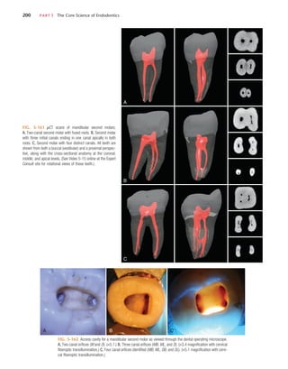 200	 PART I  The Core Science of Endodontics
FIG. 5-161  µCT scans of mandibular second molars.
A, Two-canal second molar with fused roots. B, Second molar
with three initial canals ending in one canal apically in both
roots. C, Second molar with four distinct canals. All teeth are
shown from both a buccal (vestibular) and a proximal perspec-
tive, along with the cross-sectional anatomy at the coronal,
middle, and apical levels. (See Video 5-15 online at the Expert
Consult site for rotational views of these teeth.)
A
B
C
FIG. 5-162  Access cavity for a mandibular second molar as viewed through the dental operating microscope.
A, Two canal orifices (M and D). (×5.1.) B, Three canal orifices (MB, ML, and D). (×3.4 magnification with cervical
fiberoptic transillumination.) C, Four canal orifices identified (MB, ML, DB, and DL). (×5.1 magnification with cervi-
cal fiberoptic transillumination.)
A B C
 