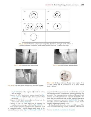 CHAPTER 5  Tooth Morphology, Isolation, and Access	 201
FIG. 5-163  Classification of C-shaped canal configuration. (From Fan B, Cheung G, Fan M, Gutmann J:
C-shaped canal system in mandibular second molars. I. Anatomical fractures, J Endod 30:899, 2004.)
C1 C2
C3 C4
C5
A B
C D
F
E
FIG. 5-164  Anastomosis of all canals into one.
FIG. 5-165  Two canals with an accessory canal at the distal root apex.
FIG. 5-166  Fusion of mesial canals at the apex.
FIG. 5-167  Mandibular third molar. Average time of eruption—17 to
21 years; average age of calcification—18 to 25 years; average
length—18.5 mm.
Fig. 5-163, B), but either angle α or β should be no less
than 60 degrees.
Category III (C3): Two or three separate canals (see Fig.
5-163, C and D) and both angles, α and β, are less than
60 degrees.
Category IV (C4): Only one round or oval canal is in the
cross-section (see Fig. 5-163, E).
Category V (C5): No canal lumen can be observed (is
usually seen near the apex only) (see Fig. 5-163, F).
The C-shaped root canal system was first reported in 1979
in a maxillary molar.43
Most C-shaped canals occur in the
mandibular second molar (Figs. 5-175 through 5-180),234
but
they also have been reported in the mandibular first molar,146
the maxillary first and second molars, and the mandibular first
premolar.* One study reported the incidence of C-shaped canal
anatomy in maxillary first molars as 2 in 2175 (0.092%); this
study also determined that the DB and palatal orifices were
connected by a common groove (see Fig. 5-176, B).53
Investiga-
tors who examined 309 Chinese maxillary second molars
found C-shaped root canals in 4.9%.254
C-shaped mandibular molars are so named because of the
cross-sectional morphology of their fused roots and their root
*References 62, 63, 65, 66, 146,150, 252, 253, 261, and 262.
 