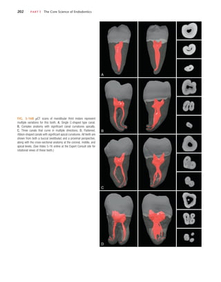 202	 PART I  The Core Science of Endodontics
FIG. 5-168  µCT scans of mandibular third molars represent
multiple variations for this tooth. A, Single C-shaped type canal.
B, Complex anatomy with significant canal curvatures apically.
C, Three canals that curve in multiple directions. D, Flattened,
ribbon-shaped canals with significant apical curvatures. All teeth are
shown from both a buccal (vestibular) and a proximal perspective,
along with the cross-sectional anatomy at the coronal, middle, and
apical levels. (See Video 5-16 online at the Expert Consult site for
rotational views of these teeth.)
A
B
C
D
 