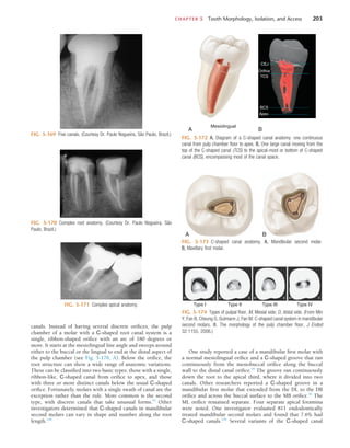 CHAPTER 5  Tooth Morphology, Isolation, and Access	 203
FIG. 5-169  Five canals. (Courtesy Dr. Paulo Nogueira, São Paulo, Brazil.)
FIG. 5-170  Complex root anatomy. (Courtesy Dr. Paulo Nogueira, São
Paulo, Brazil.)
FIG. 5-171  Complex apical anatomy.
FIG. 5-172  A, Diagram of a C-shaped canal anatomy: one continuous
canal from pulp chamber floor to apex. B, One large canal moving from the
top of the C-shaped canal (TCS) to the apical-most or bottom of C-shaped
canal (BCS), encompassing most of the canal space.
Mesiolingual
A B
CEJ
BCS
Apex
Orifice
TCS
FIG. 5-173  C-shaped canal anatomy. A, Mandibular second molar.
B, Maxillary first molar.
B
A
FIG. 5-174  Types of pulpal floor. M, Mesial side; D, distal side. (From Min
Y, Fan B, Cheung G, Gutmann J, Fan M: C-shaped canal system in mandibular
second molars. III. The morphology of the pulp chamber floor, J Endod
32:1155, 2006.)
Type I
M D
Type II
M D
Type III
M D
Type IV
M D
canals. Instead of having several discrete orifices, the pulp
chamber of a molar with a C-shaped root canal system is a
single, ribbon-shaped orifice with an arc of 180 degrees or
more. It starts at the mesiolingual line angle and sweeps around
either to the buccal or the lingual to end at the distal aspect of
the pulp chamber (see Fig. 5-176, A). Below the orifice, the
root structure can show a wide range of anatomic variations.
These can be classified into two basic types: those with a single,
ribbon-like, C-shaped canal from orifice to apex, and those
with three or more distinct canals below the usual C-shaped
orifice. Fortunately, molars with a single swath of canal are the
exception rather than the rule. More common is the second
type, with discrete canals that take unusual forms.43
Other
investigators determined that C-shaped canals in mandibular
second molars can vary in shape and number along the root
length.136
One study reported a case of a mandibular first molar with
a normal mesiolingual orifice and a C-shaped groove that ran
continuously from the mesiobuccal orifice along the buccal
wall to the distal canal orifice.18
The groove ran continuously
down the root to the apical third, where it divided into two
canals. Other researchers reported a C-shaped groove in a
mandibular first molar that extended from the DL to the DB
orifice and across the buccal surface to the MB orifice.26
The
ML orifice remained separate. Four separate apical foramina
were noted. One investigator evaluated 811 endodontically
treated mandibular second molars and found that 7.6% had
C-shaped canals.239
Several variants of the C-shaped canal
 