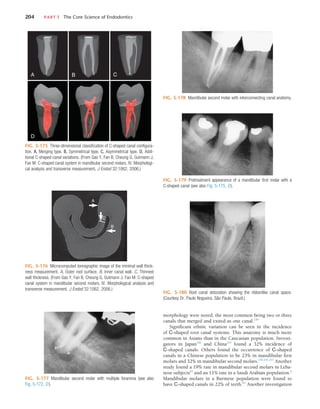 204	 PART I  The Core Science of Endodontics
FIG. 5-176  Microcomputed tomographic image of the minimal wall thick-
ness measurement. A, Outer root surface. B, Inner canal wall. C, Thinnest
wall thickness. (From Gao Y, Fan B, Cheung G, Gutmann J, Fan M: C-shaped
canal system in mandibular second molars. IV. Morphological analysis and
transverse measurement, J Endod 32:1062, 2006.)
A
C
B
FIG. 5-177  Mandibular second molar with multiple foramina (see also
Fig. 5-172, D ).
FIG. 5-178  Mandibular second molar with interconnecting canal anatomy.
FIG. 5-179  Pretreatment appearance of a mandibular first molar with a
C-shaped canal (see also Fig. 5-175, D ).
FIG. 5-180  Root canal obturation showing the ribbonlike canal space.
(Courtesy Dr. Paulo Nogueira, São Paulo, Brazil.)
morphology were noted, the most common being two or three
canals that merged and exited as one canal.239
Significant ethnic variation can be seen in the incidence
of C-shaped root canal systems. This anatomy is much more
common in Asians than in the Caucasian population. Investi-
gators in Japan106
and China254
found a 32% incidence of
C-shaped canals. Others found the occurrence of C-shaped
canals in a Chinese population to be 23% in mandibular first
molars and 32% in mandibular second molars.254,255,257
Another
study found a 19% rate in mandibular second molars in Leba-
nese subjects85
and an 11% rate in a Saudi Arabian population.6
Mandibular molars in a Burmese population were found to
have C-shaped canals in 22% of teeth.82
Another investigation
FIG. 5-175  Three-dimensional classification of C-shaped canal configura-
tion. A, Merging type. B, Symmetrical type. C, Asymmetrical type. D, Addi-
tional C-shaped canal variations. (From Gao Y, Fan B, Cheung G, Gutmann J,
Fan M: C-shaped canal system in mandibular second molars. IV. Morphologi-
cal analysis and transverse measurement, J Endod 32:1062, 2006.)
C
B
A
D
 