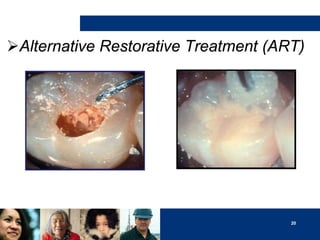 Alternative Restorative Treatment (ART)

20

 