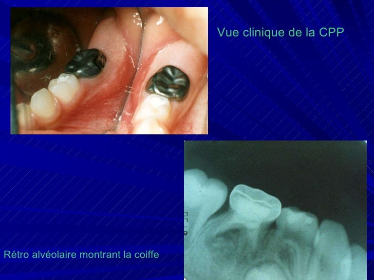 Couronne Dentaire Pédiatrique En Acier Inoxydable Pour Enfants - Pour Molaires Primaires, Modèles D/E