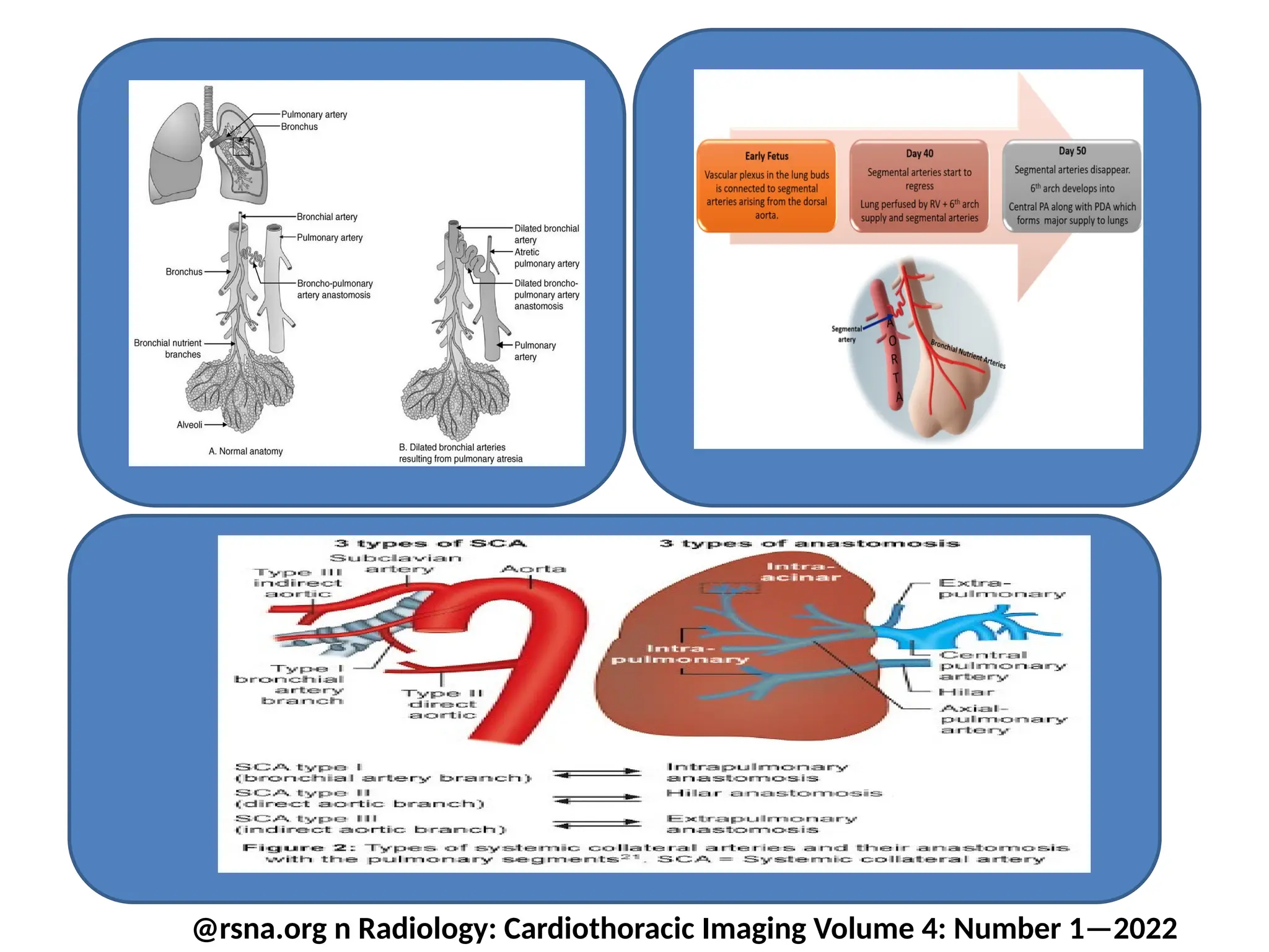 Coiling of Major Aortopulmonary Collateral Arteries (MAPCAs.pptx
