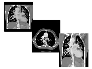 Coiling of Major Aortopulmonary Collateral Arteries (MAPCAs.pptx