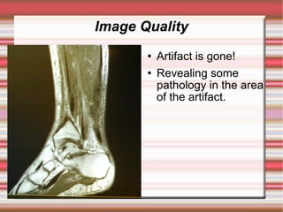 Image Quality
          Artifact is gone!
          Revealing some
           pathology in the area
           of the artifact.
 