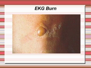 EKG Burn
 