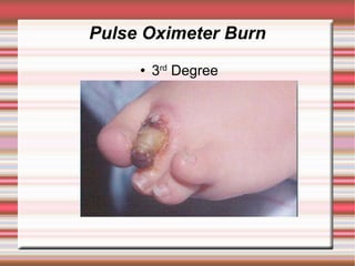 Pulse Oximeter Burn
        3rd Degree
 
