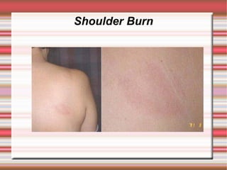 Shoulder Burn
 