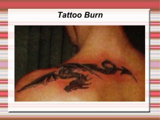 Tattoo Burn
 