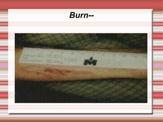 Burn--
 
