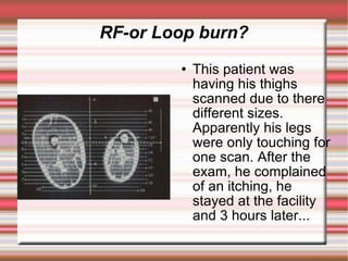 RF-or Loop burn?
           This patient was
            having his thighs
            scanned due to there
            different sizes.
            Apparently his legs
            were only touching for
            one scan. After the
            exam, he complained
            of an itching, he
            stayed at the facility
            and 3 hours later...
 