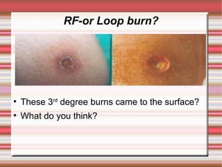 RF-or Loop burn?





    These 3rd degree burns came to the surface?

    What do you think?
 