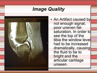 Image Quality
          An Artifact caused by
           not enough signal,
           poor uneven fat-
           saturation. In order to
           see the top of the
           tibia the window level
           had to be increased
           dramatically, causing
           the fluid to be to
           bright and the
           articular cartilage
           unseen.
 