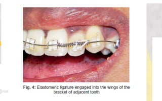 Orthodontic Coil spring