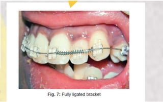 Orthodontic Coil spring