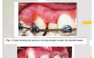 Orthodontic Coil spring
