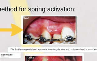 Orthodontic Coil spring
