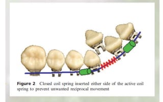 Orthodontic Coil spring