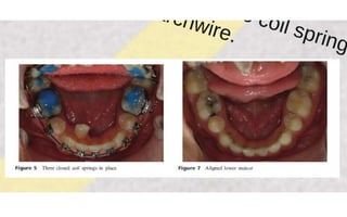 Orthodontic Coil spring