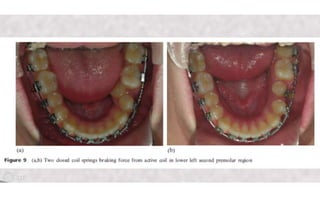 Orthodontic Coil spring