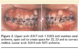 Orthodontic Coil spring