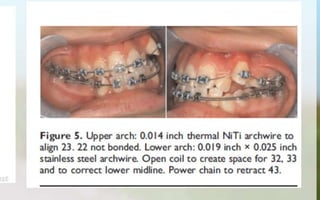 Orthodontic Coil spring