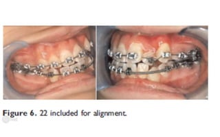 Orthodontic Coil spring
