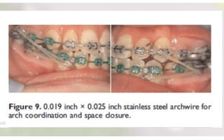 Orthodontic Coil spring