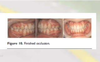 Orthodontic Coil spring
