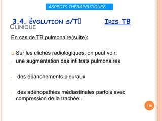 ASPECTS THÉRAPEUTIQUES


 3.4. ÉVOLUTION S/Tᵌ                     IRIS TB
CLINIQUE
En cas de TB pulmonaire(suite):

   Sur les clichés radiologiques, on peut voir:
-   une augmentation des infiltrats pulmonaires

-   des épanchements pleuraux

-    des adénopathies médiastinales parfois avec
    compression de la trachée..
                                                   110
 