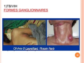 1)TB/VIH
FORMES GANGLIONNAIRES


-superficielles (le + souvent cervicales),axillaire:
assez précoces dans le déficit immunitaire



- profondes, médiastinales ou abdominales
pouvant s’associer à des abcès viscéraux,
hépatiques ou spléniques
                                                       46
 