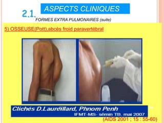 ASPECTS CLINIQUES
       2.1.FORMES EXTRA PULMONAIRES (suite)
5) OSSEUSE(Pott),abcès froid paravertébral




                                                             49


                                         (AIDS 2001 ; 15 : 55-60)
 