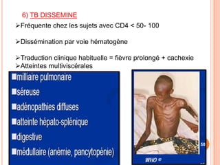 6) TB DISSEMINE
Fréquente chez les sujets avec CD4 < 50- 100

Dissémination par voie hématogène

Traduction clinique habituelle = fièvre prolongé + cachexie
Atteintes multiviscérales




                                                               50
 