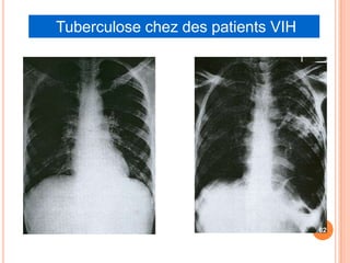 Tuberculose chez des patients VIH




                                                 62

Miliaire tuberculeuse   Tuberculose pulmonaire
 