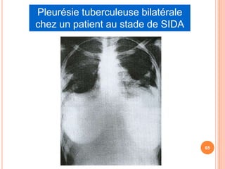 Pleurésie tuberculeuse bilatérale
chez un patient au stade de SIDA




                                    65
 
