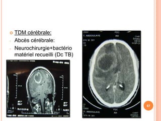   TDM cérébrale:
-   Abcès cérébrale:
-   Neurochirurgie+bactério
    matériel recueilli (Dc TB)




                                 67
 