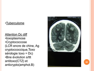 •Tuberculome


Attention Dc diff
•toxoplasmose
•Cryptococcose
(LCR encre de chine, Ag
cryptoccoccique,Toxo
sérologie toxo = Dc)
•Bne évolution s/ttt
antitoxo(CTZ) et          68
anticrypto(amphot.B)
 