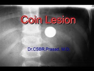 Coin Lesion

 Dr.CSBR.Prasad, M.D.


      CSBRP-Dec-2012
 