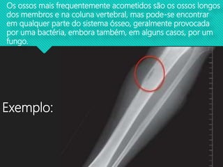 Exemplo:
Os ossos mais frequentemente acometidos são os ossos longos
dos membros e na coluna vertebral, mas pode-se encontrar
em qualquer parte do sistema ósseo, geralmente provocada
por uma bactéria, embora também, em alguns casos, por um
fungo.
 