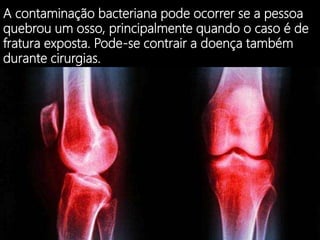 A contaminação bacteriana pode ocorrer se a pessoa
quebrou um osso, principalmente quando o caso é de
fratura exposta. Pode-se contrair a doença também
durante cirurgias.
 