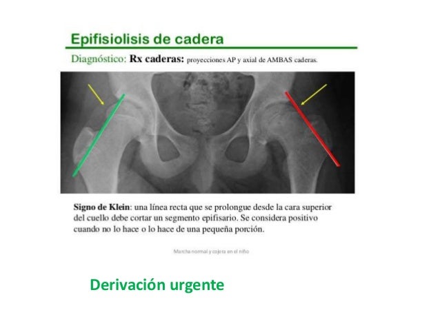 El cinturón elástico para los riñones a la osteocondrosis
