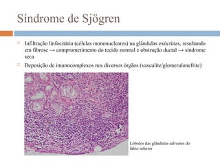 Síndrome de Sjögren
 Infiltração linfocitária (células mononucleares) na glândulas exócrinas, resultando
em fibrose → comprometimento do tecido normal e obstrução ductal → síndrome
seca
 Deposição de imunocomplexos nos diversos órgãos (vasculite/glomerulonefrite)
Lóbulos das glândulas salivares do
lábio inferior
 