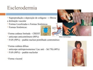 Esclerodermia
 Superprodução e deposição de colágeno → fibrose
e disfunção vascular
 Formas Localizadas x Formas Sistêmicas
 Formas Sistêmicas:
 Forma cutânea limitada – CREST
 anticorpo anticentrômero (80%)
 FAN (90%) – padrão nuclear pontilhado centromérico
 Forma cutânea difusa
 anticorpo antitopoisomerase I (ac anti – Scl 70) (40%)
 FAN (90%) – padrão nucleolar
 Forma visceral
 
