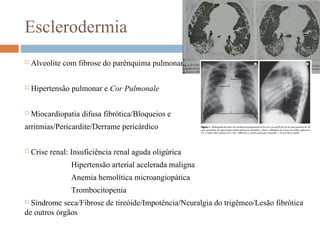Esclerodermia
 Alveolite com fibrose do parênquima pulmonar
 Hipertensão pulmonar e Cor Pulmonale
 Miocardiopatia difusa fibrótica/Bloqueios e
arritmias/Pericardite/Derrame pericárdico
 Crise renal: Insuficiência renal aguda oligúrica
Hipertensão arterial acelerada maligna
Anemia hemolítica microangiopática
Trombocitopenia
 Síndrome seca/Fibrose de tireóide/Impotência/Neuralgia do trigêmeo/Lesão fibrótica
de outros órgãos
 