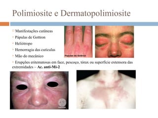 Polimiosite e Dermatopolimiosite
 Manifestações cutâneas
 Pápulas de Gottron
 Heliótropo
 Hemorragia das cutículas
 Mão do mecânico
 Erupções eritematosas em face, pescoço, tórax ou superfície extensora das
extremidades – Ac. anti-Mi-2
 